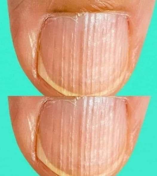 Doctor Reveals 7 Health Conditions You Can Spot By Just Checking Your Nails